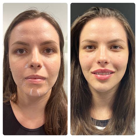 Armonización Facial Y El Plasma En Gel Tratamientos En Que Los