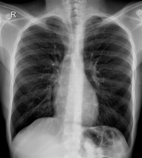 Coarctation of the aorta | Image | Radiopaedia.org