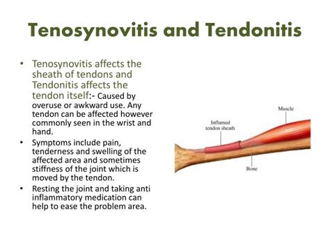 Flexor Tendon Tenosynovitis