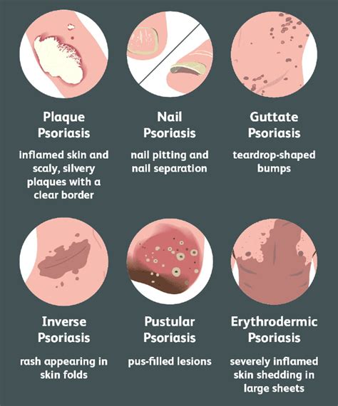 Psoriasis Causes Psoriasis Causes Psoriasis Is A Skin Disease That