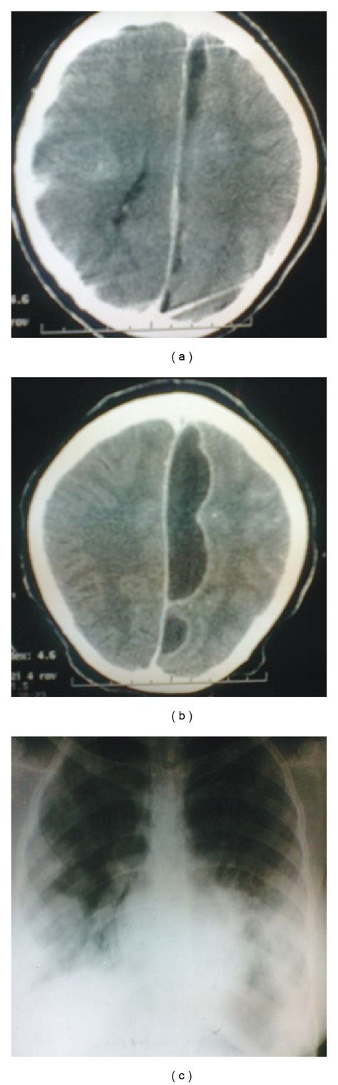 A Cranial Ct Scan Of The Patient Showing A Hypodense Lesion In The