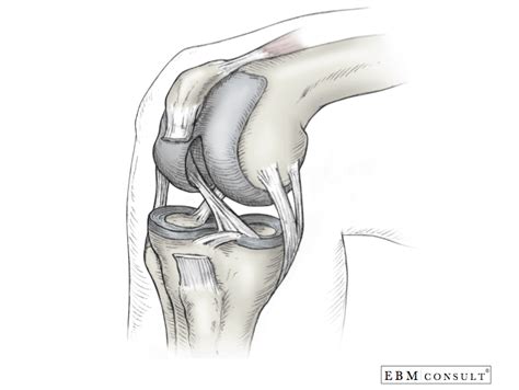 Tendons attach the knee muscles to the bone. Síndrome da Dor Patelofemoral - O GUIA COMPLETO - Parte 2