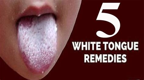 5 Home Remedies For A White Coated Tongue By Top 5 Youtube