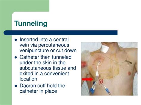 Non Tunneled Catheter Vs Tunneled Catheter