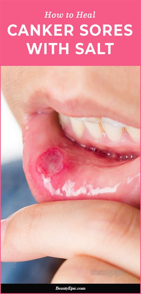 How Does Salt Help Heal Canker Sores