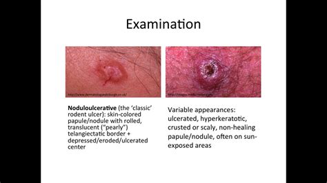 Dermatology Basal Cell Carcinoma And Squamous Cell Carcinoma Youtube