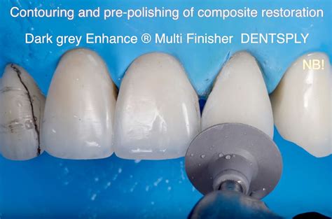 Operative Dentistry Direct Restoration Of Frontal Teeth Finishing