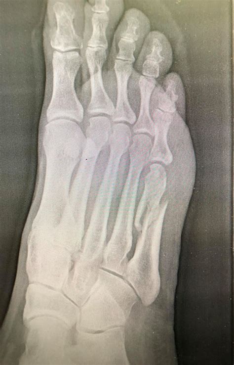 Fifth Metatarsal Fracture Orthopaedic Specialists Of Louisville