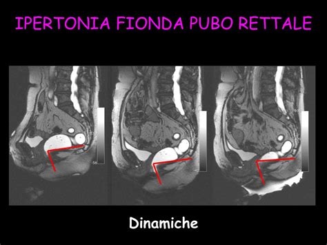 Ppt Imaging Della Pelvi Femminile Attualita Oncologica E Colon