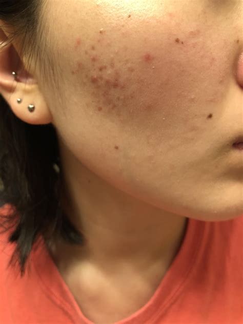 Skin Concerns Help Ive Had This Spot Of Red Bumps Painless Not
