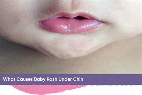 Baby Rash Under Chin Drool Rash Heat Rash Contact Dermatitis