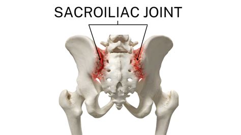 Sacroiliac SI Joint Dysfunction Orthopaedic Spine Surgery Singapore