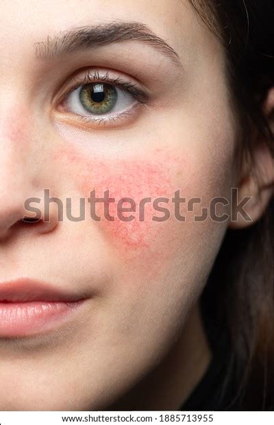 Case Early Rosacea On Young Womans Stock Photo 1885713955 Shutterstock