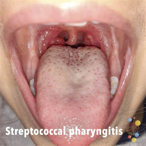 Streptococcal Pharyngitis Rash