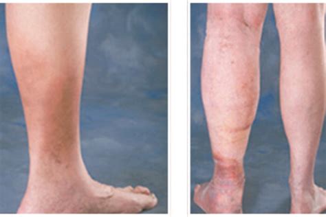 Ankle Discoloration Inovia Vein Specialty Centers Oregon Vein