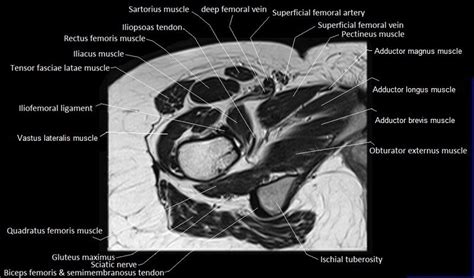 Mri Anatomy Of Hip Joint Free Mri Axial Hip Anatomy In Hip