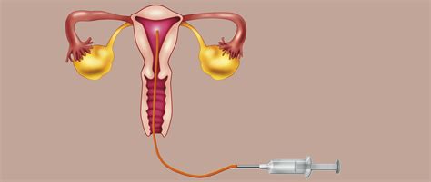 Donor Insemination In Spain How Does It Work