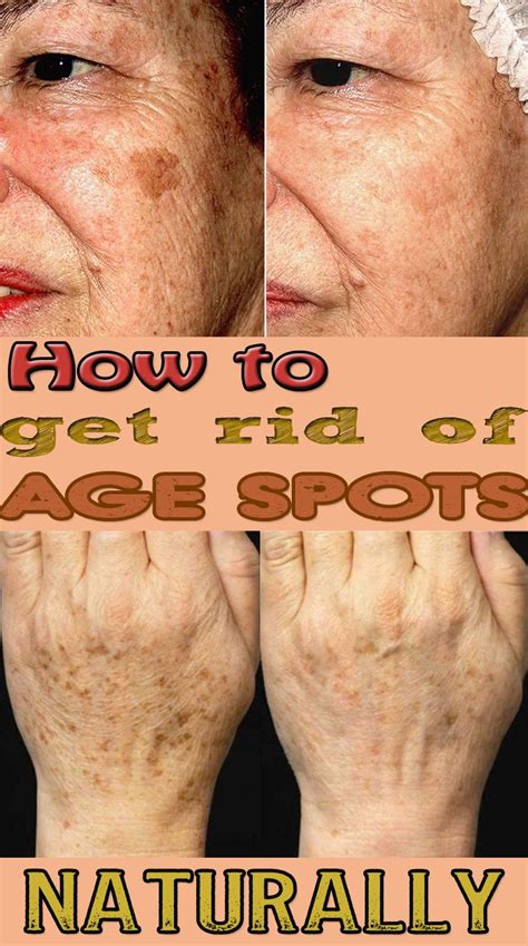 How To Get Rid Of Age Spots Naturally Age Spots On Face Spots On Face