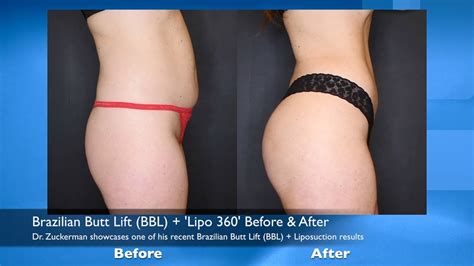 When can i resume my activities? Brazilian Butt Lift (BBL) + 'Lipo 360' Before & After ...