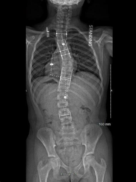 Spinal Technology Sct 3d Wilmington Style Scoliosis Brace