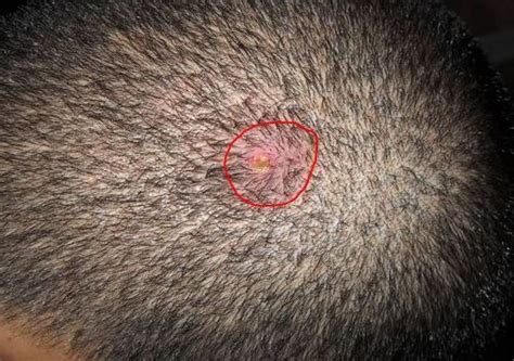 Bumps On Scalp Small Red Pictures Itchy Bumps Under Hair That Hurts