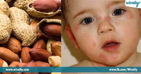 6 Things You Need To Know About Food Allergies Wirally