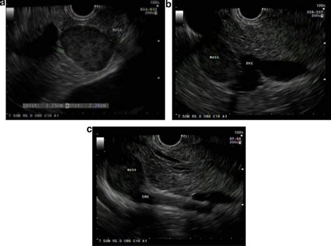 Endoscopic Ultrasound Images Demonstrate A Predominantly Hypoechoic