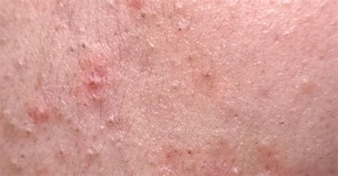 Nodular Acne Causes Treatment Home Remedies And More