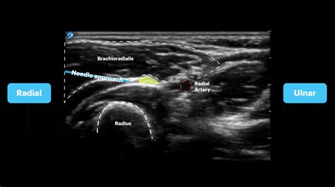 Forearm Nerve Blocks Image Atlas — Tpa