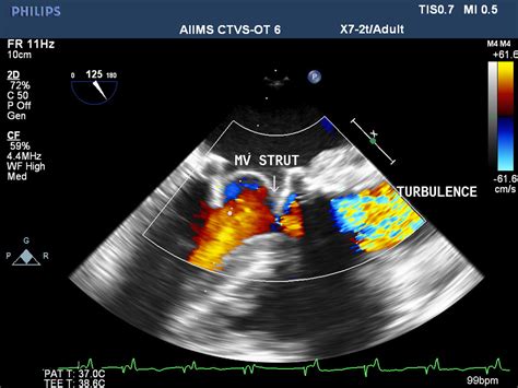 Prosthetic Mitral Valve Strut Masquerading As Left Ventricular Outflow