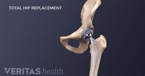 Total Hip Replacement Surgical Procedure