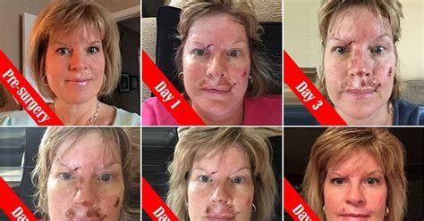 This Is What Skin Cancer Looks Like Shocking Pictures Show The Results Of Invasive 27000