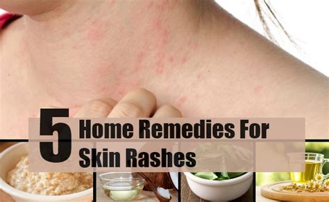 5 Home Remedies For Skin Rashes Natural Treatments And Cure For Skin