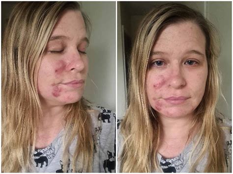 Woman Hails £85 Skincare Kit As ‘miracle Cure For Her Cystic Acne