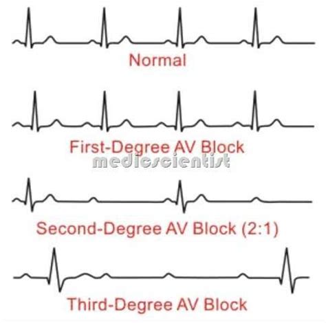 Heart block may cause no symptoms. Pin on Cardiac and Vascular