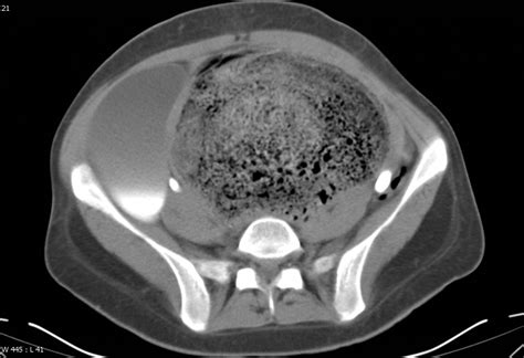 Fecal Impaction Eurorad