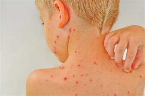 Chickenpox Symptoms Treatment Stages And Causes