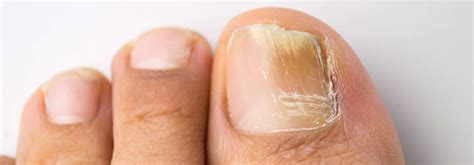 Fungal Infections Vitalskin Dermatology