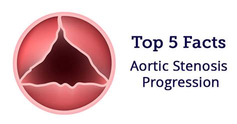 Aortic Stenosis Progression 5 Facts Patients Should Know