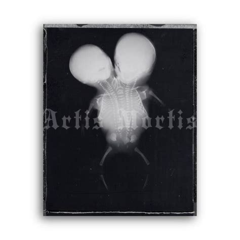 Printable X Ray Conjoined Siamese Twins Medical Radiology Poster