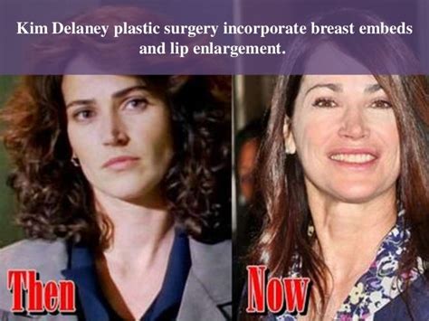 Kim Delaney Plastic Surgery