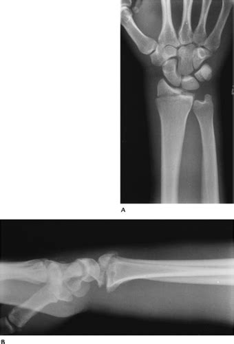 Hand and Wrist | Radiology Key