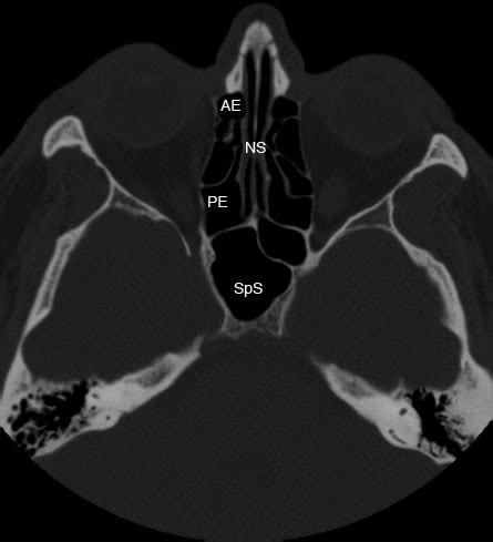 Technology And Techniques In Radiology CT Axial Image Showing Normal Ethmoid Sinus Anatomy