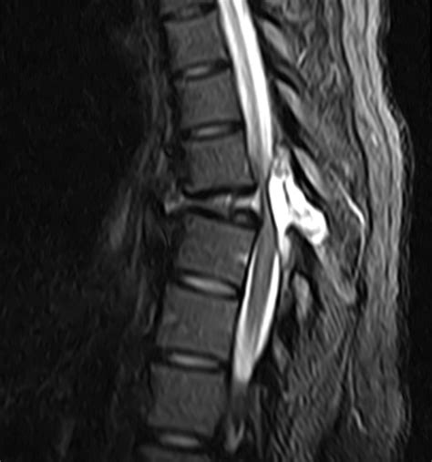 Aneurysmal Bone Cyst Spine Image