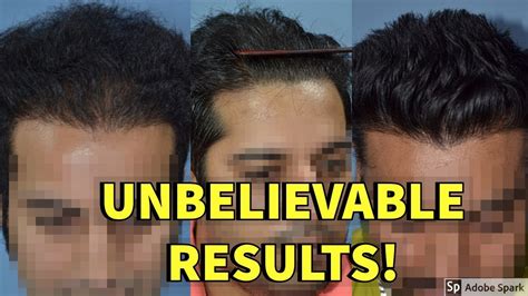 As we claim to provide you best of services all over india. BEST HAIR TRANSPLANT CLINIC IN INDIA!! - YouTube