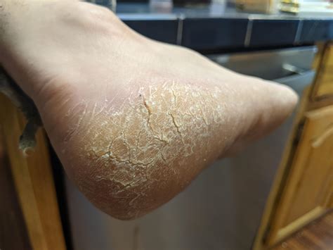 Skin Concerns Painful Dry Cracking Skin On Feet What Would Be The