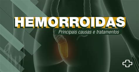 Hemorroidas Como Tratar Cl Nica G Strica Usuy