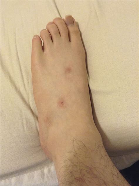 Bed Bug Bites On My Legs For Months My Feet Was Never Clean Of Bites