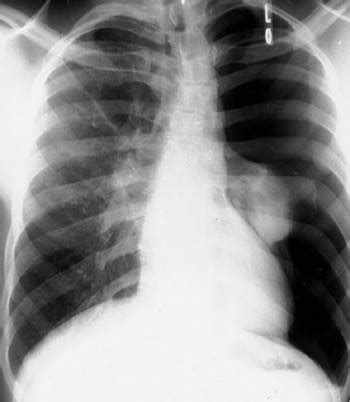 A pneumothorax is an abnormal collection of air in the pleural space between the lung and the chest wall. Pneumothorax - Lungen- und Atemwegserkrankungen - MSD ...