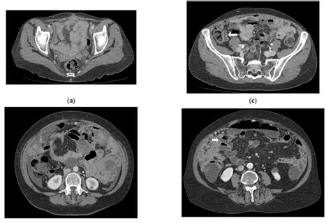 Ct Enterography For Preoperative Evaluation Of Peritoneal Carcinomatosis Index In Advanced